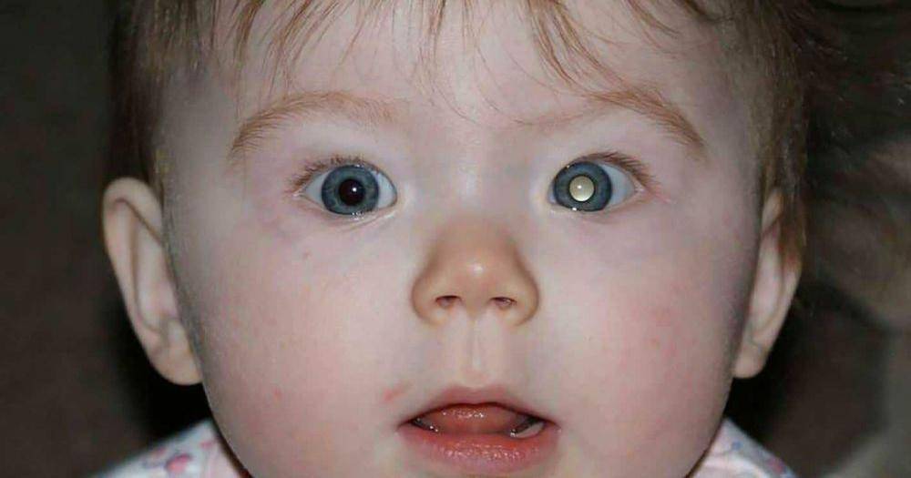Retinoblastoma: Gejala, Penyebab, Cara Pengobatan, dan Tingkat Stadium
